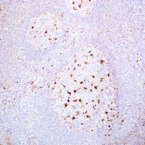 AAT (Alpha-1 -Antitrypsin )