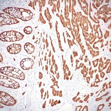 Villin標(biāo)記人結(jié)腸癌